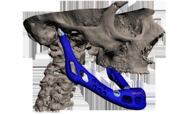 In der Medizin konnte die 3D-Druck-Technologie bereits  überzeugen. Die vollständig gedruckte Kieferprothese wurde bereits  erfolgreich implantiert und sorgte für mediale Aufmerksamkeit.