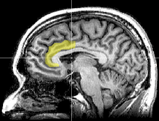 ACC anterioren cingulären Cortex MRI 