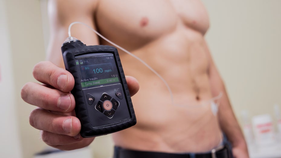 Insulinpumpen müssen mehrfach am Tag eingestellt und daher „greifbar“ getragen werden. Damit könnte demnächst Schluss sein. (Foto: Roman Zaiets/ Shutterstock) Erste Smartphone-App für Insulinpumpe medizinisch zugelassen