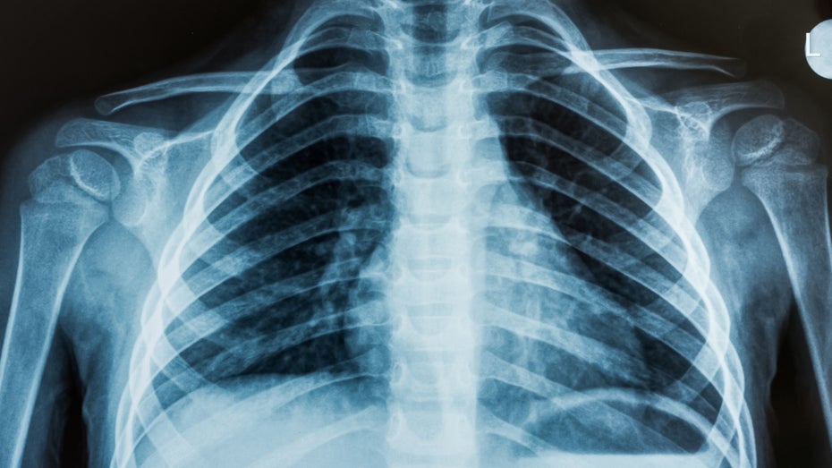 KI analysiert erstmals Röntgenbild ohne Radiologen