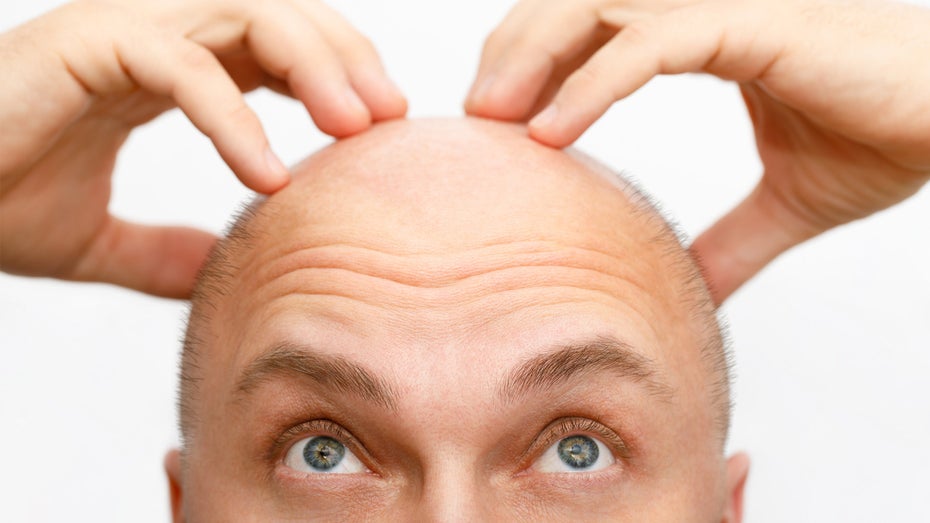 KI gegen Glatze: Forscher entwickeln Mikronadelpflaster, das Haar wiederherstellt