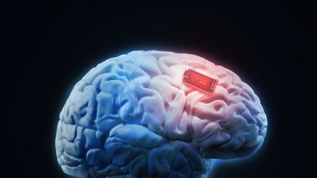Nicht nur Neuralink: Wie weit andere Startups bei Gehirnimplantaten sind