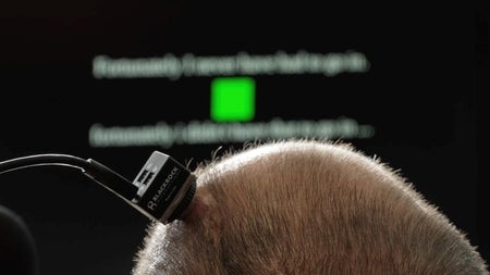 Vom Schweigen zum Gesang: Wie ein Hirn-Chip einem ALS-Patienten die Stimme zurückgab